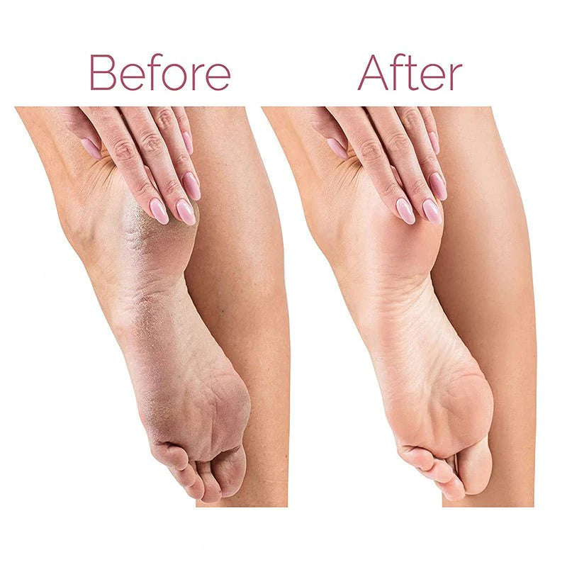Electric Pedicure Foot File Callus Remover | Rechargeable Foot Scrubber for Smooth & Soft Heels
